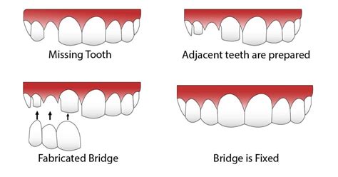 dental bridge cost india