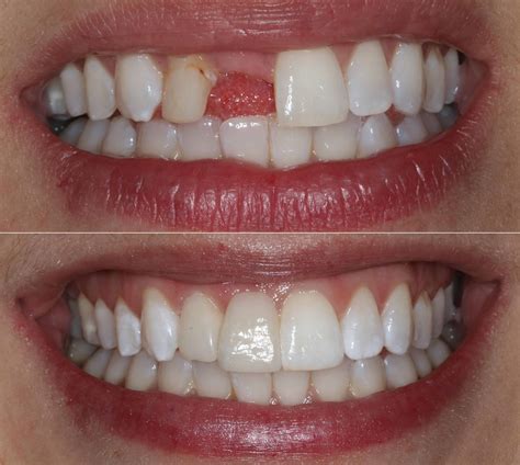 dental bridge front tooth