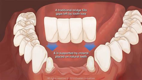 Dental Bridge Gap
