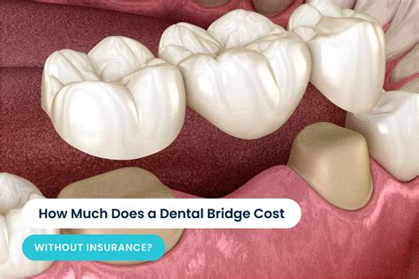 dental bridge price range