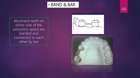 Dental Code For Band And Loop