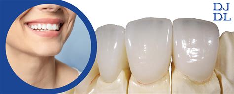 Dental Code For Emax Crown