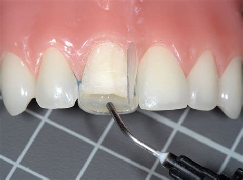 Dental Code For Strip Crowns
