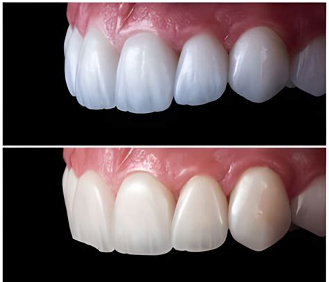 Dental Composite Emax