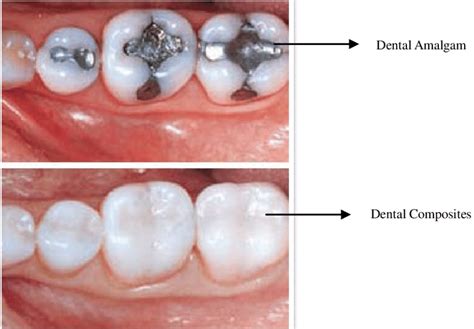Dental Composite Meaning