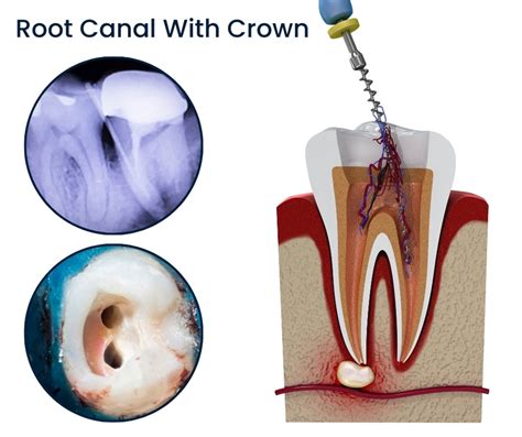 Dental Coverage For Root Canal