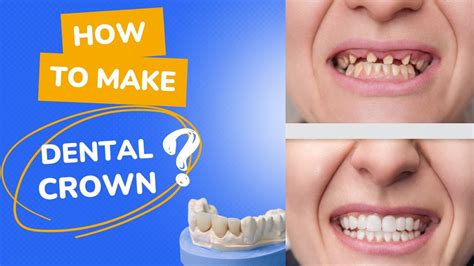 Dental Crown Making