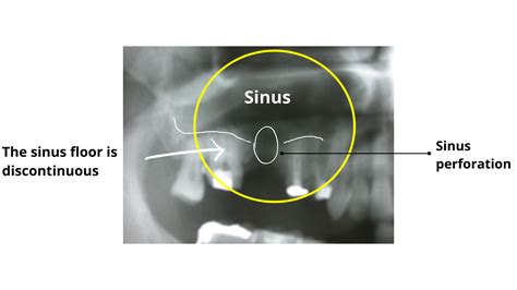 Dental Extraction Sinus Perforation