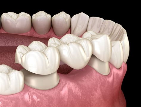 dental implant alternative options