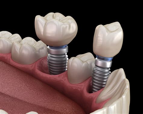 dental implant for two teeth