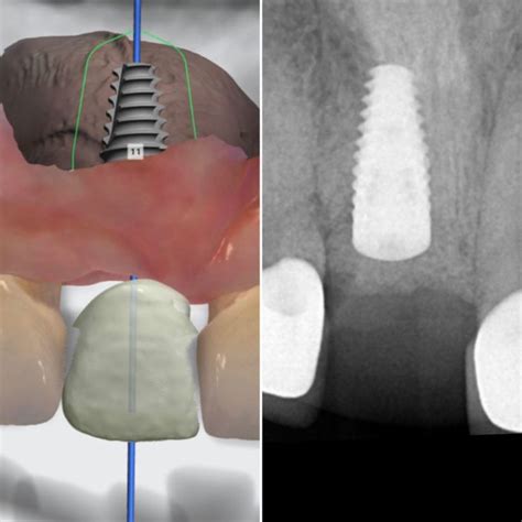 dental implant placement courses