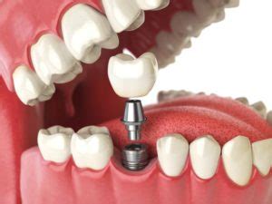 dental implants bedford uk