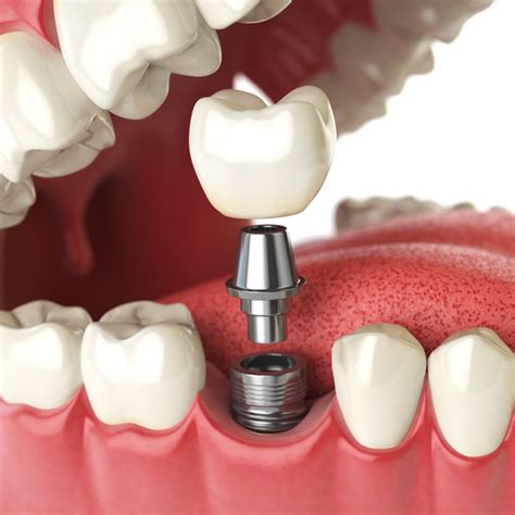 dental implants dentists nearby