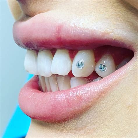 Dental Implants Diamonds