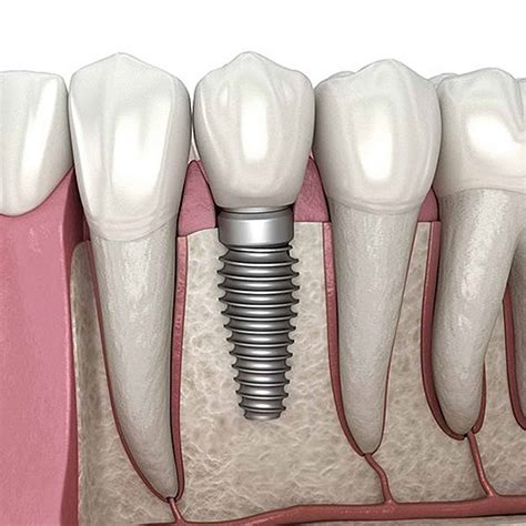 dental implants fresno