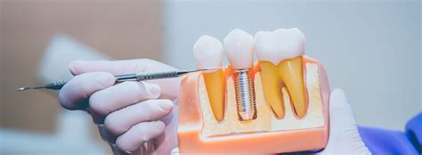 dental implants in 67208