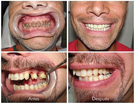 dental implants in mexico best rated dentists