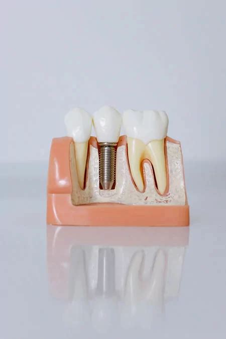 dental implants in oklahoma city