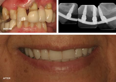 dental implants in tucson az