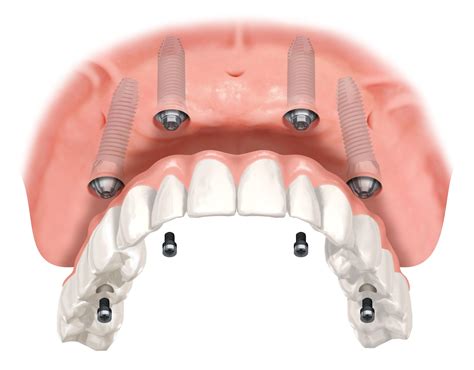 dental implants in uk cost