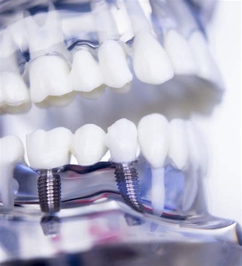 dental implants naples fl reviews