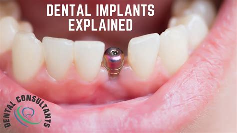 dental implants near me low cost plans