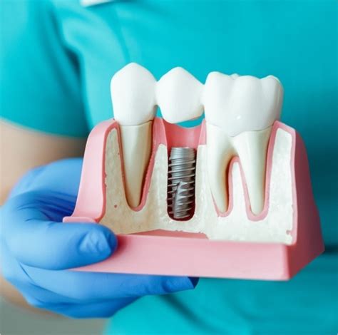 dental implants oklahoma city cost