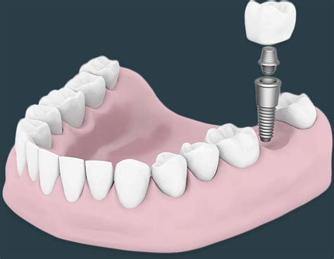Dental Implants St Charles