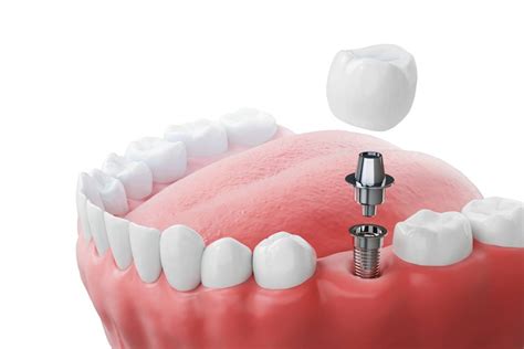 Dental Implants Without Screws