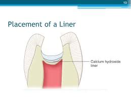 Dental Liners Definition