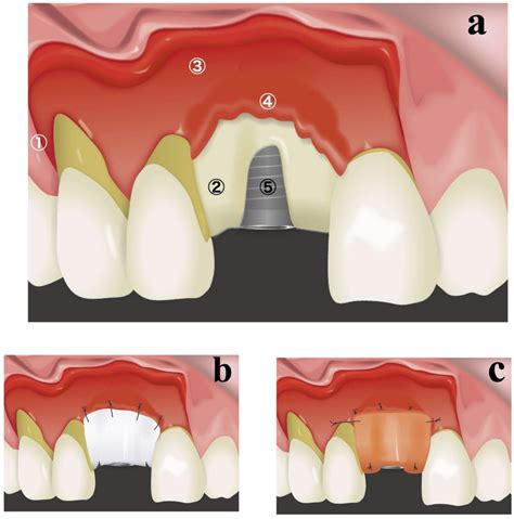 Dental Membrane