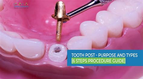 Dental Post Placement