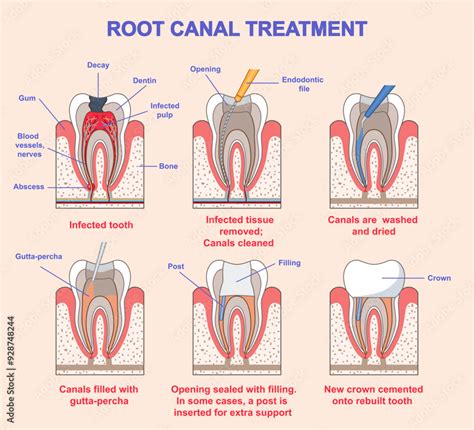 Dental Problems Post Root Canal