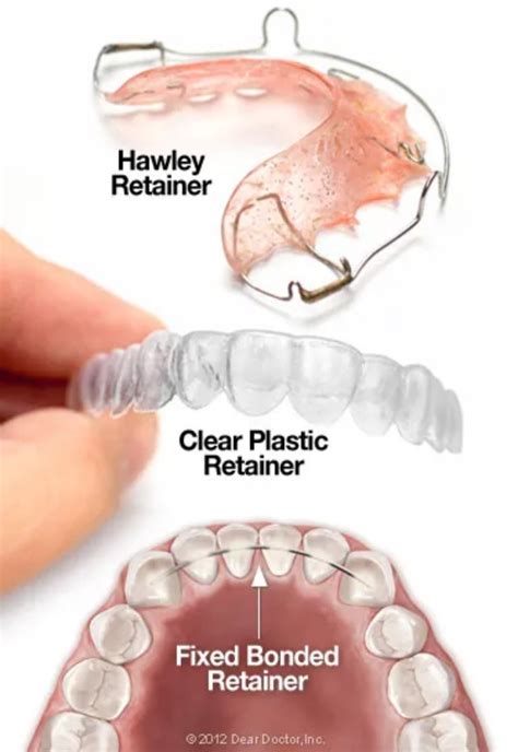 Dental Retainer Definition
