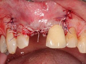 Dental Stitches Fall Out