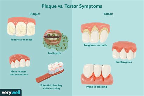 dental tartar vs plaque vs calculus