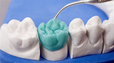 Dental Wax Pattern