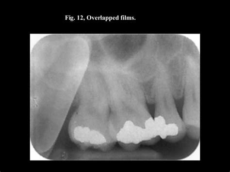 Dental X-Ray Film Processing Errors