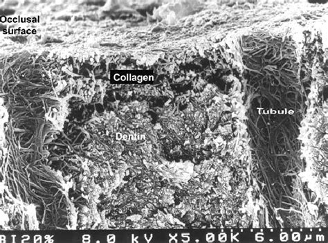 Dentin After Etching