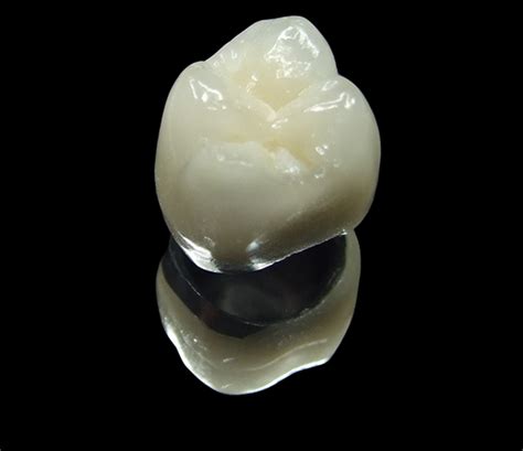Dentin Bonded Crown