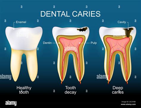 Dentin Caries Definition