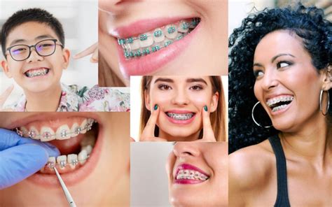 Dentist Chicago Braces