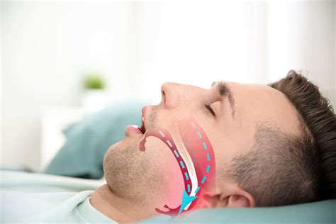 dentist for sleep apnea