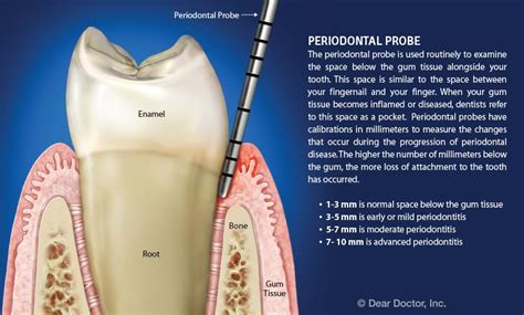 Dentist Probe Gums