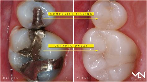 Dentist Replacing Silver Fillings