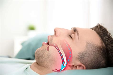 dentists specializing in sleep apnea