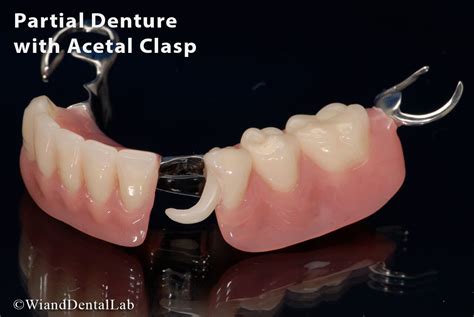 Denture Clasps Types