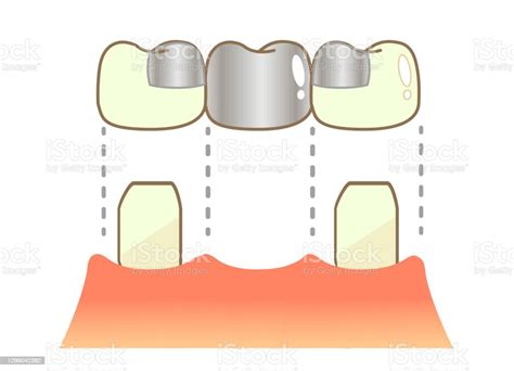 denture crown bridge