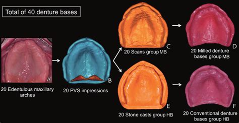 Denture Impression With Pvs