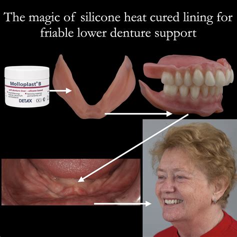 Denture Liners For Partials